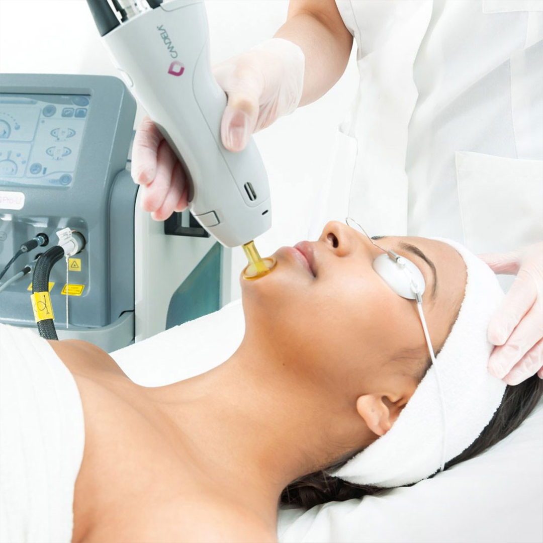1 Brazilian 1 Full Face Laser Hair Removal Or 1 Beardlining For Men 